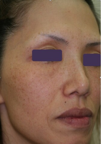 Gentle Max Pro Plusを使用したレーザーフェイシャルビフォー画像