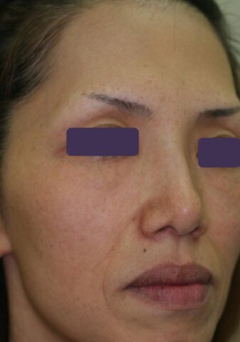 Gentle Max Pro Plusを使用したレーザーフェイシャルアフター画像