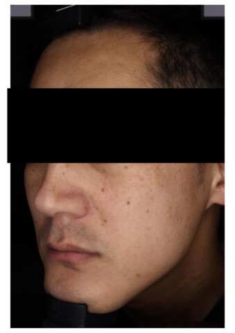 Qスイッチルビーレーザーを使用したシミ治療アフター画像