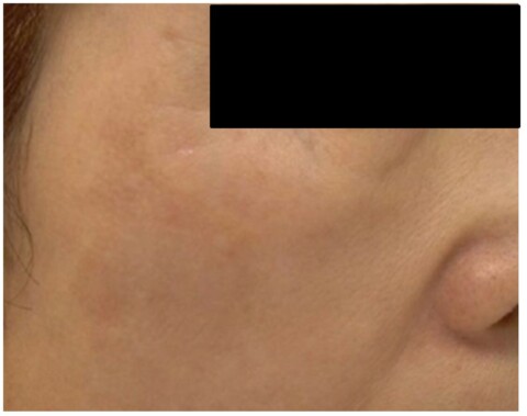 Nordlys（IPL）を使用したシミの治療アフター画像