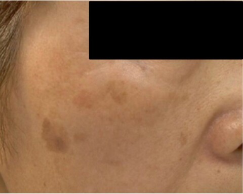 Nordlys（IPL）を使用したシミの治療ビフォー画像