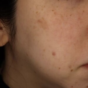 ピコレーザー（PicoWay）によるシミ治療 before