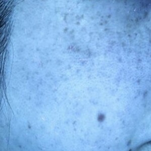 ピコレーザー（PicoWay）を使用したシミ治療 after