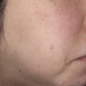 ピコレーザー（PicoWay）によるシミ治療 after