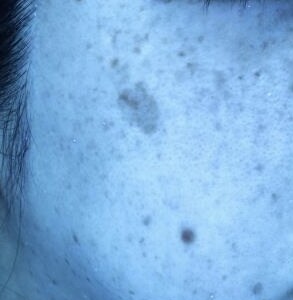 ピコレーザー（PicoWay）を使用したシミ治療 before