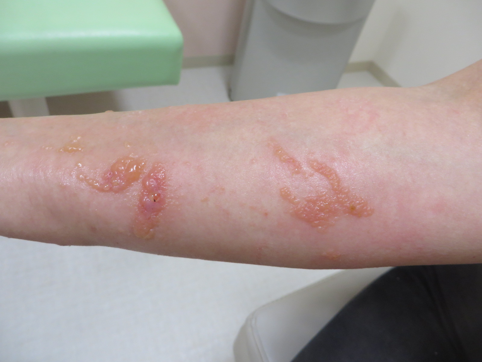 無視される皮膚炎はどのように診断されますか?